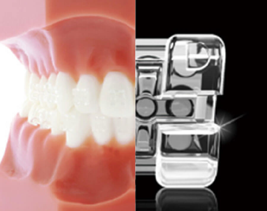 矯正装置の種類と特徴