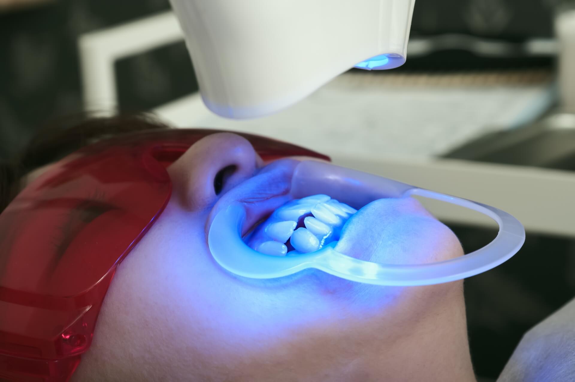 オフィスホワイトニングとは？