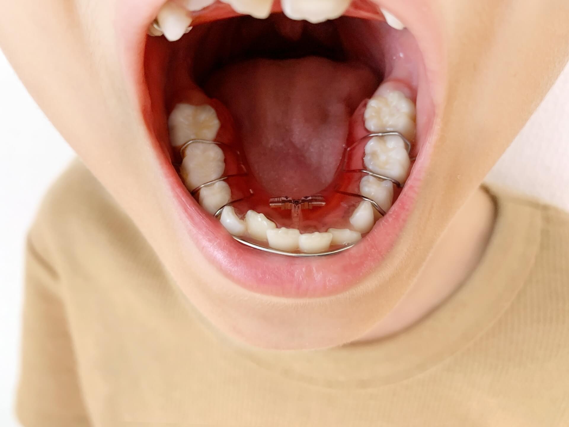 小児矯正が生活に与える影響